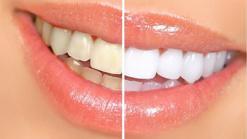 Before and after teeth whitening results