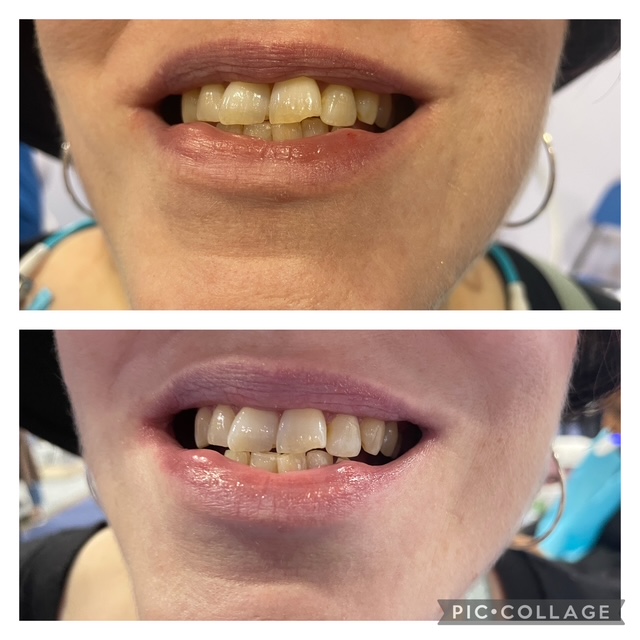 Before and after teeth whitening result following one Gellen Pearl treatment