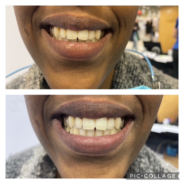 Before and after teeth whitening result following one Gellen Pearl treatment