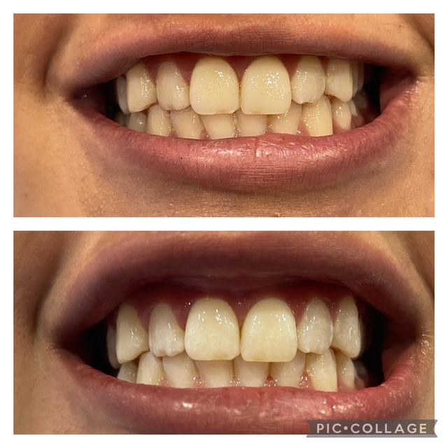 Before and after teeth whitening result following one Gellen Pearl treatment