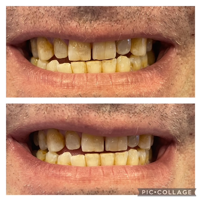 Before and after teeth whitening result following one Gellen Pearl treatment