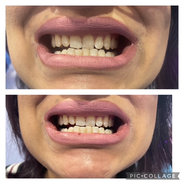 Before and after teeth whitening result following one Gellen Pearl treatment