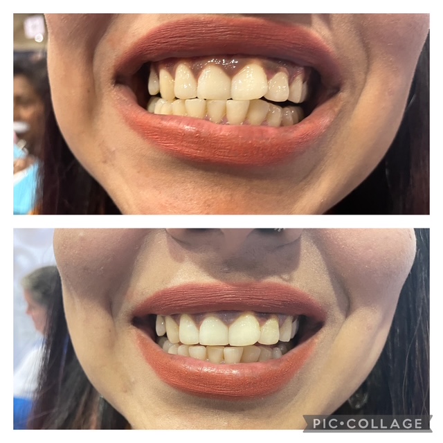 Before and after teeth whitening result following one Gellen Pearl treatment