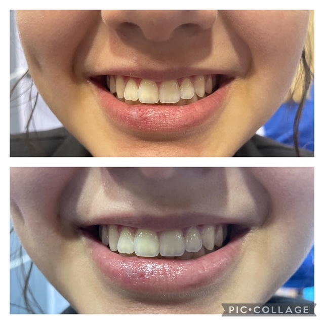 Before and after teeth whitening result following one Gellen Pearl treatment