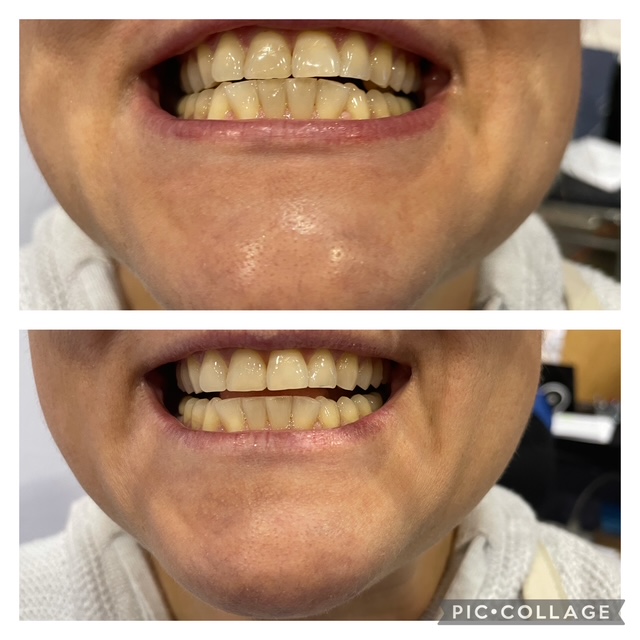 Before and after teeth whitening result following one Gellen Pearl treatment