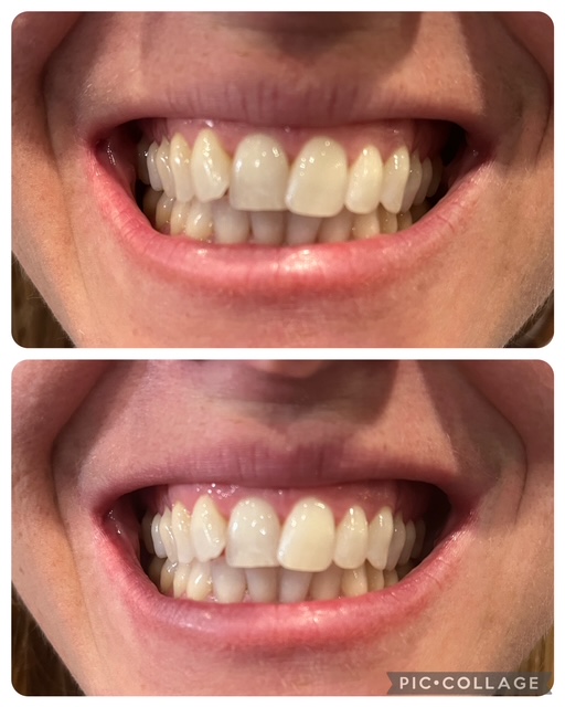 Before and after teeth whitening result following one Gellen Pearl treatment