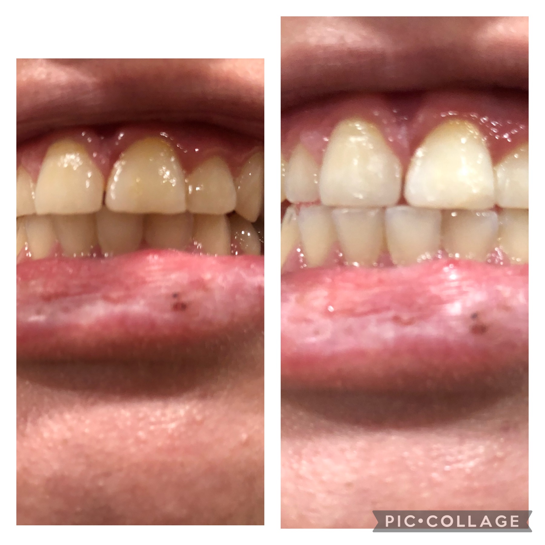 Before and after teeth whitening result following one Gellen Pearl treatment