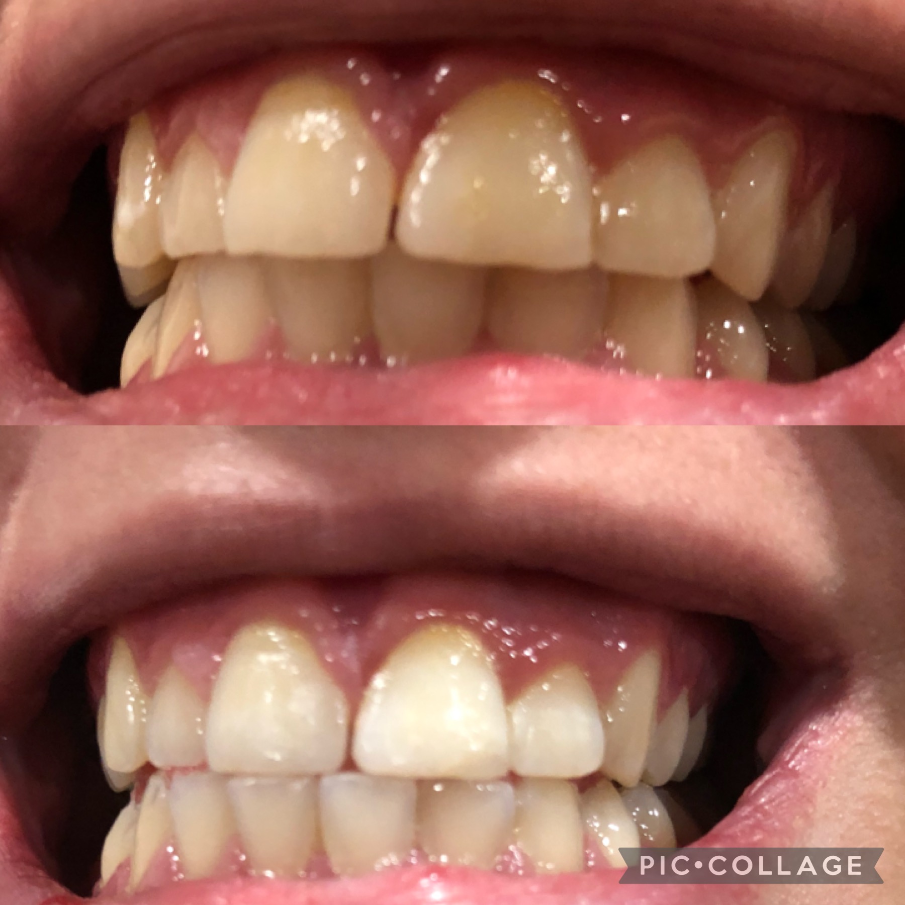 Before and after teeth whitening result following one Gellen Pearl treatment
