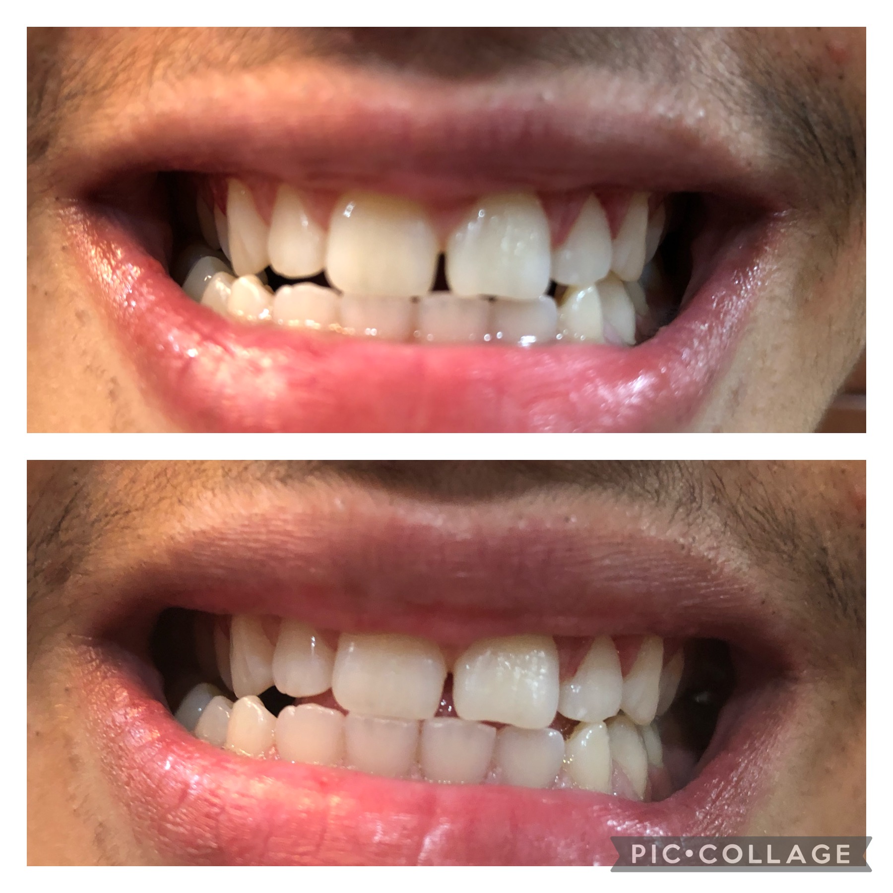 Before and after teeth whitening result following one Gellen Pearl treatment