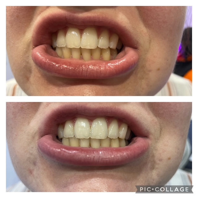 Before and after teeth whitening result following one Gellen Pearl treatment