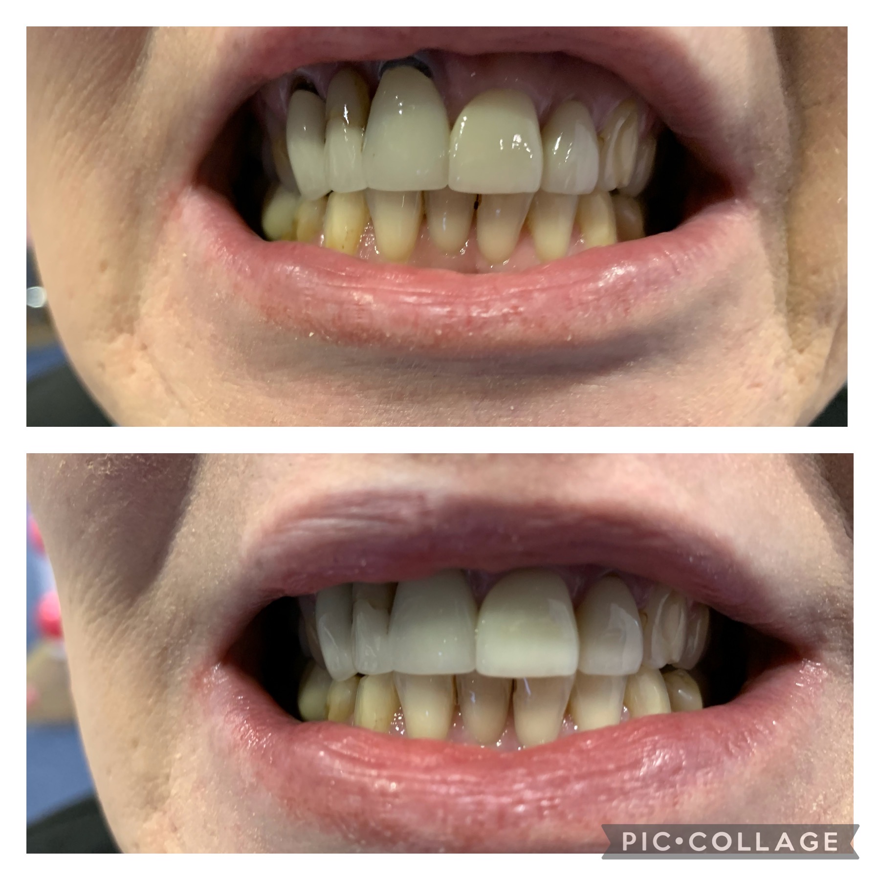 Before and after teeth whitening result following one Gellen Pearl treatment