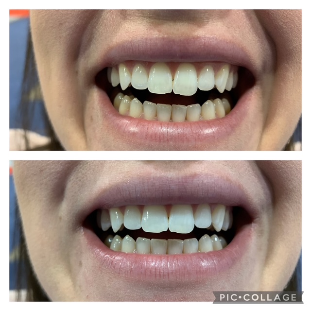 Before and after teeth whitening result following one Gellen Pearl treatment