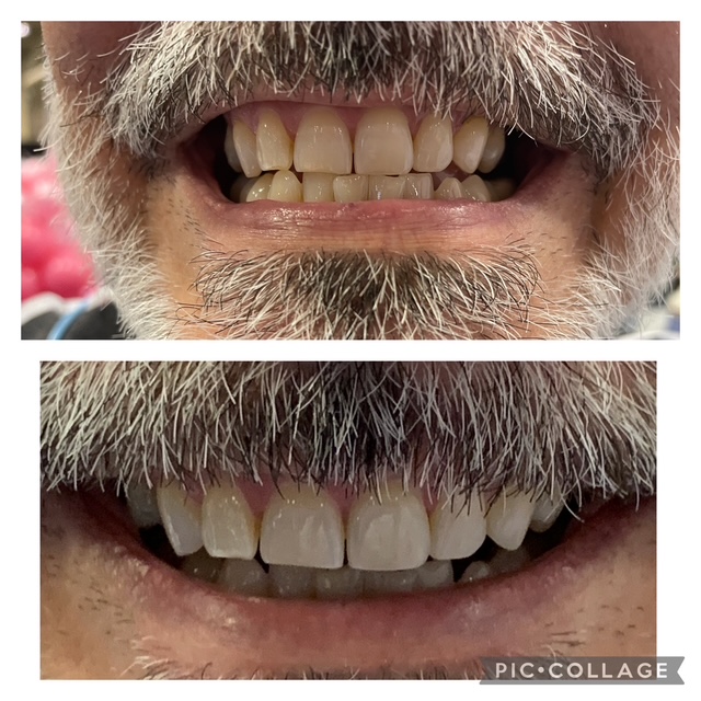 Before and after teeth whitening result following one Gellen Pearl treatment